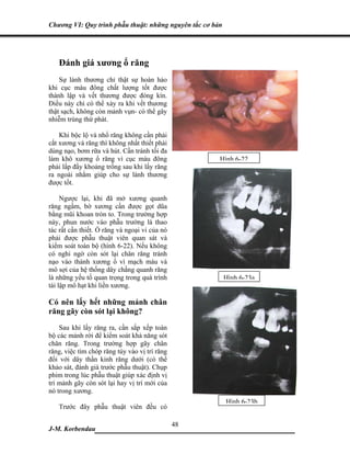 Chương VI: Quy trình phẫu thuật: những nguyên tắc cơ bản




   Đánh giá xương ổ răng
    Sự lành thương chỉ thật sự hoàn hảo
khi cục máu đông chất lượng tốt được
thành lập và vết thương được đóng kín.
Điều này chỉ có thể xảy ra khi vết thương
thật sạch, không còn mảnh vụn- có thể gây
nhiễm trùng thứ phát.

    Khi bộc lộ và nhổ răng không cần phải
cắt xương và răng thì không nhất thiết phải
dùng nạo, bơm rữa và hút. Cần tránh tối đa
làm khô xương ổ răng vì cục máu đông                   Hình 6-22
phải lấp đầy khoảng trống sau khi lấy răng
ra ngoài nhằm giúp cho sự lành thương
được tốt.

     Ngược lại, khi đã mở xương quanh
răng ngầm, bờ xương cần được gọt dũa
bằng mũi khoan tròn to. Trong trường hợp
này, phun nước vào phẫu trường là thao
tác rất cần thiết. Ổ răng và ngoại vi của nó
phải được phẫu thuật viên quan sát và
kiểm soát toàn bộ (hình 6-22). Nếu không
có nghi ngờ còn sót lại chân răng tránh
nạo vào thành xương ổ vì mạch máu và
mô sợi của hệ thống dây chằng quanh răng
là những yếu tố quan trọng trong quá trình                 Hình 6-23a
tái lập mô hạt khi liền xương.

Có nên lấy hết những mảnh chân
răng gãy còn sót lại không?
    Sau khi lấy răng ra, cần sắp xếp toàn
bộ các mảnh rời để kiểm soát khả năng sót
chân răng. Trong trường hợp gãy chân
răng, việc tìm chóp răng tùy vào vị trí răng
đối với dây thần kinh răng dưới (có thể
khảo sát, đánh giá trước phẫu thuật). Chụp
phim trong lúc phẫu thuật giúp xác định vị
trí mảnh gãy còn sót lại hay vị trí mới của
nó trong xương.
                                                           Hình 6-23b
   Trước đây phẫu thuật viên đều có

                              48
J-M. Korbendau   ___________________________________
 