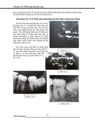 Chương VII: Phẫu thuật lấy mầm răng

gây tê vùng hay tại chỗ. Trong giai đoạn này, phẫu thuật không phải không có biến chứng,
nên phẫu thuật là đúng hay sai vẫn còn đang bàn cãi.

   Giai đoạn II: 12-15 tuổi, quá trình khoáng hóa thân răng hoàn thành
    Sự calci hóa thân răng bắt đầu sau 10 tuổi.
Khoảng tuổi 14, sự thành lập chân răng mới
khởi đầu. Trong giai đoạn này, trần của bao
mầm răng không thông với môi trường bên
ngoài. Việc phẫu thuật nhằm tạo lỗ thông vào
bao mầm răng để hướng dẫn răng mọc là
không thỏa đáng vì mầm răng tự xác định
hướng mọc đứng. Khi phẫu thuật, cần cắt thân
răng thành nhiều mảnh nhỏ (thường đã đạt
kích thước thật của nó).

    Lấy mầm răng trong điều trị chỉnh hình,
khi cần thêm khoảng trống sau hàm (hình 7-
3). Lấy mầm răng còn giúp R7 mọc hoàn toàn                   Hình 7-3
và đúng vị trí hay khi mầm răng bất
thường một cách có ý nghĩa (hình 7-4; 7-
5a; 7-5b).




                                                           Hình 7-4




                 Hình 7-5a


                                                             Hình 7-5b




                              53
J-M. Korbendau   ___________________________________
 