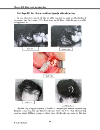 Chương VII: Phẫu thuật lấy mầm răng


   Giai đoạn III: 14- 18 tuổi, sự thành lập một phần chân răng
   Sự mọc răng được xem là bắt đầu khi chân răng thứ hai calci hóa (Korbendau &
Guyomard; Van Der Linden, 1983). Răng trong tư thế đứng và bắt đầu mọc trên phần
xương phía xa R7.




               Hình 7-6 a                                 Hình 7-6 b




                                      Hình 7-6c




             Hình 7-7a
                                                            Hình 7-7b
    Lấy mầm răng trong giai đoạn này là tốt nhất, vì xương bao phủ bên trên bao mầm răng
đang tiêu và thân răng nằm ngay bên dưới niêm mạc (hình 7-6a; 7-6b; 7-6c). Khi mầm răng
trong bao của nó thì không có nguy cơ nhiễm trùng. Nên lấy mầm răng trước khi thân răng



                             54
J-M. Korbendau  ___________________________________
 