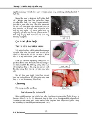 Chương VII: Phẫu thuật lấy mầm răng

mọc lên niêm mạc vì tránh được nguy cơ nhiễm khuẩn cộng sinh trong mô nha chu (hình 7-
7a;7-7b).

    Khám lâm sàng và khảo sát tia X nhằm đánh
giá kỹ khoảng mọc răng. Nếu trường hợp không
yêu cầu phẫu thuật, cần chụp X-quang định kỳ
theo dõi sự phát triễn răng. Cần nhấn mạnh một
lần nữa, tuổi đang phát triển không thể được sử
dụng làm tiêu chí để quyết định thời điểm phẫu
thuật lấy răng ngầm. Tuy nhiên, phẫu thuật lấy
răng trong giai đoạn này thì đơn giản và nhanh, vì
thân răng ở ngay dưới niêm mạc và chân răng
thành lập một phần.
                                                                 Hình 7-8

   Qui trình phẫu thuật
   Tạo vạt niêm mạc màng xương
    Một số trường hợp má lấn vào phần niêm mạc
tam giác hậu hàm, tạo thành một gờ mô mềm
(hình 7-8). Lúc đó, bờ mô nha chu phía xa R7 có
thể ở vị trí mặt nhai của nó. (hình 7-9a;7-9b).

    Rạch tạo vạt niêm mạc màng xương theo các
giai đoạn đã nói trên. Bóc tách niêm mạc tam giác
hậu hàm phía lưỡi đến bờ trong xương ổ R7. Khi
cắt xương hay răng, có thể dùng cây nạy hay banh               Hình 7-9a
đưa sâu xuống dưới bảo vệ vạt niêm mạc phía
lưỡi.

   Khi kết thúc phẫu thuật, có thể loại bỏ một
phần mô nướu phía xa R7 nhằm giúp răng mọc
đúng vị trí sau lành thương (hình 7-10).

   Cắt xương
   Cắt xương gồm hai giai đoạn.                                  Hình 7-9b

           Loại bỏ xương che phủ mầm R

   Dùng mũi khoan tròn loại bỏ trần bao mầm răng bằng cách tạo nhiều lỗ nhỏ (Komet or
Thomas) (hình 7-11a; 7-11b). Kiểm soát từng hố được tạo ra, dựa vào sự khác nhau về tính
chất của men và xương, giữa xương và bao mầm răng bên dưới. Lấy toàn bộ phần xương
bên trên bằng đục hay bằng mũi khoan (hình 7-12a).



                             55
J-M. Korbendau  ___________________________________
 