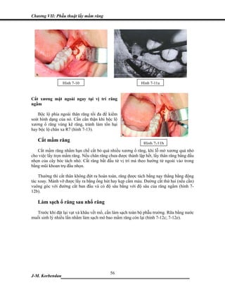 Chương VII: Phẫu thuật lấy mầm răng




                 Hình 7-10                                  Hình 7-11a


Cắt xương mặt ngoài ngay tại vị trí răng
ngầm

    Bộc lộ phía ngoài thân răng tối đa để kiểm
soát hình dạng của nó. Cần cẩn thận khi bộc lộ
xương ổ răng vùng kẽ răng, tránh làm tổn hại
hay bộc lộ chân xa R7 (hình 7-13).

   Cắt mầm răng
                                                             Hình 7-11b
   Cắt mầm răng nhằm hạn chế cắt bỏ quá nhiều xương ổ răng, khi lỗ mở xương quá nhỏ
cho việc lấy trọn mầm răng. Nếu chân răng chưa được thành lập hết, lấy thân răng bằng đầu
nhọn của cây bóc tách nhỏ. Cắt răng bắt đầu từ vị trí má theo hướng từ ngoài vào trong
bằng mũi khoan trụ đầu nhọn.

    Thường thì cắt thân không đứt ra hoàn toàn, răng được tách bằng nạy thẳng bằng động
tác xoay. Mảnh vỡ được lấy ra bằng ống hút hay kẹp cầm máu. Đường cắt thứ hai (nếu cần)
vuông góc với đường cắt ban đầu và có độ sâu bằng với độ sâu của răng ngầm (hình 7-
12b).

   Làm sạch ổ răng sau nhổ răng
  Trước khi đặt lại vạt và khâu vết mổ, cần làm sạch toàn bộ phẫu trường. Rữa bằng nước
muối sinh lý nhiều lần nhằm làm sạch mô bao mầm răng còn lại (hình 7-12c; 7-12e).




                             56
J-M. Korbendau  ___________________________________
 