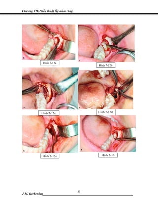 Chương VII: Phẫu thuật lấy mầm răng




                 Hình 7-12a
                                      Hình 7-12b




             Hình 7-12c               Hình 7-12d




              Hình 7-12e                Hình 7-13




                           57
J-M. Korbendau___________________________________
 