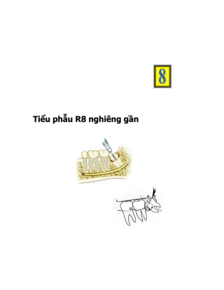 Tiểu phẫu R8 nghiêng gần
 