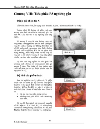 Chương VIII: Tiểu phẫu R8 nghiêng gần


Chương VIII: Tiểu phẫu R8 nghiêng gần

   Đánh giá phim tia X
   Đối với R8 mọc lệch, ấn tượng chẩn đoán tia X gồm 3 điểm sau (hình 8-1a; 8-1b):

   Đường nhai R8 hướng về phía cành cao
xương hàm dưới tạo với trục răng một góc lớn
hơn 900. Góc này chỉ ra độ nghiêng của răng
ngầm.

    Bờ xương ổ răng là một đường cong mở
rộng từ bờ xương phía xa R8 đến đỉnh xương kẽ
răng R7 và R6. Đường này không được lầm lẫn
với bờ trước cành cao xương hàm dưới, thường
có hình chếch nghiêng. Khi lật vạt niêm mạc
màng xương, phẫu thuật viên có thể thấy cổ                   Hình 8-1a
răng có vị trí trên bờ xương ổ răng này: phần
còn lại của răng nằm trong bao mầm răng.

   Độ sâu của răng ngầm có liên quan với
khoảng cách đường nối men-cement đến gờ
xương ổ răng. Nếu toàn bộ răng ngầm nằm
chếch về phía gần thì tạo thuận lợi cho việc đặt
nạy (hình 8-1c).

   Độ khó của phẫu thuật
   Sau khi nghiên cứu kỹ phim tia X, phẫu                      Hình 8-1b
thuật viên cần đánh giá độ khó của cuộc phẫu
thuật và có thể quyết định có nên tiến hành phẫu
thuật hay không. Độ khó tùy vào vị trí răng và
hình thái chân của nó. Cụ thể như sau: (hình 8-
2)
   • Độ sâu của răng nằm trong xương.
   • Khoảng cách giữa R7 và cành cao xương
        hàm dưới.

   Độ sâu R8 được đánh giá trong mối quan hệ
với R7 (Độ A, B, C hình 8-2), và nhìn chung
cho ta biết lượng xương cần lấy ra. Vì thế, thái
độ phẫu thuật tùy thuộc chủ yếu vào những yếu                  Hình 8-1c




                             59
J-M. Korbendau  ___________________________________
 