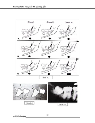 Chương VIII: Tiểu phẫu R8 nghiêng gần




                                 Hình 8-2




              Hình 8-3
                                            Hình 8-4




                           60
J-M. Korbendau___________________________________
 