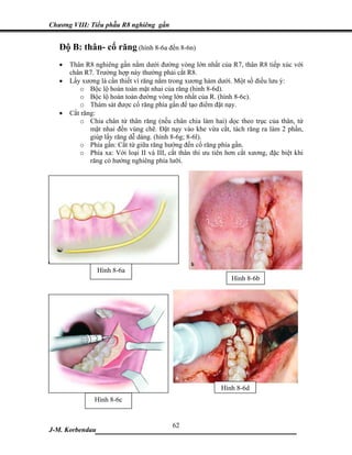 Chương VIII: Tiểu phẫu R8 nghiêng gần


   Độ B: thân- cổ răng (hình 8-6a đến 8-6n)
   •   Thân R8 nghiêng gần nằm dưới đường vòng lớn nhất của R7, thân R8 tiếp xúc với
       chân R7. Trường hợp này thường phải cắt R8.
   •   Lấy xương là cần thiết vì răng nằm trong xương hàm dưới. Một số điều lưu ý:
          o Bộc lộ hoàn toàn mặt nhai của răng (hinh 8-6d).
          o Bộc lộ hoàn toàn đường vòng lớn nhất của R. (hình 8-6c).
          o Thám sát được cổ răng phía gần để tạo điểm đặt nạy.
   •   Cắt răng:
          o Chia chân từ thân răng (nếu chân chia làm hai) dọc theo trục của thân, từ
              mặt nhai đến vùng chẽ. Đặt nạy vào khe vừa cắt, tách răng ra làm 2 phần,
              giúp lấy răng dễ dàng. (hình 8-6g; 8-6l).
          o Phía gần: Cắt từ giữa răng hướng đến cổ răng phía gần.
          o Phía xa: Với loại II và III, cắt thân thì ưu tiên hơn cắt xương, đặc biệt khi
              răng có hướng nghiêng phía lưỡi.




                 Hình 8-6a
                                                               Hình 8-6b




                                                            Hình 8-6d
               Hình 8-6c


                             62
J-M. Korbendau  ___________________________________
 