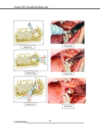 Chương VIII: Tiểu phẫu R8 nghiêng gần




                                        Hình 8-6f
          Hình 8-6e




             Hình 8-6g                  Hình 8-6h




             Hình 8-6i
                                        Hình 8-6j




                           63
J-M. Korbendau___________________________________
 