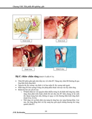 Chương VIII: Tiểu phẫu R8 nghiêng gần




            Hình 8-6k                                      Hình 8-6l




               Hình 8-6n                                Hình 8-6m



   Độ C: thân- chân răng (hình 8-7a đến 8-7e)
   •   Thân R8 (phía gần) gần như tiếp xúc với chân R7. Dạng này chân R8 thường đi qua
       ống thần kinh răng dưới.
   •   Nguyên tắc lấy xương: xác định vị trí bao mầm R, lấy xương mặt ngoài.
   •   Phần răng lồi trên xương ổ răng cho phép phẫu thuật viên tựa vào lấy chân răng.
   •   Khám kỹ tìm các yếu tố sau:
          o Ở bệnh nhân trẻ với nguyên nhân nhiễm trùng là chỉ định nhổ răng hay chân
              răng chưa phát triển hoàn chỉnh thì mô nha chu R7 nhìn chung sẽ tái sinh
              tốt. Quan trọng hơn nữa, không có nguy cơ tổn thương thần kinh răng dưới
              (hình 8-8a; 8-8-b).
          o Nhổ răng với sự hiện diện của nang do răng hay các sang thương khác. Lúc
              này, lấy răng đồng thời với lấy nang hay giải quyết những thương tổn vùng
              quanh chân R7.


                             64
J-M. Korbendau  ___________________________________
 