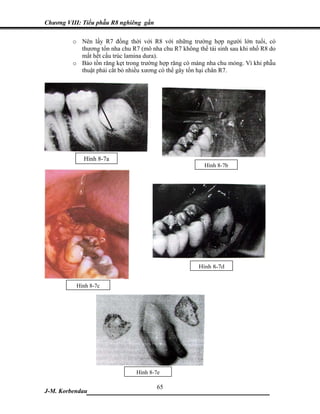 Chương VIII: Tiểu phẫu R8 nghiêng gần

         o Nên lấy R7 đồng thời với R8 với những trường hợp người lớn tuổi, có
           thương tổn nha chu R7 (mô nha chu R7 không thể tái sinh sau khi nhổ R8 do
           mất hết cấu trúc lamina dura).
         o Bảo tồn răng kẹt trong trường hợp răng có màng nha chu mỏng. Vì khi phẫu
           thuật phải cắt bỏ nhiều xương có thể gây tổn hại chân R7.




             Hình 8-7a
                                                         Hình 8-7b




                                                       Hình 8-7d

          Hình 8-7c




                                Hình 8-7e

                           65
J-M. Korbendau___________________________________
 