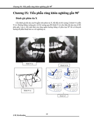Chương IX: Tiểu phẫu răng khôn nghiêng gần 900


Chương IX: Tiểu phẫu răng khôn nghiêng gần 90o
   Đánh giá phim tia X
   Cần đánh giá độ sâu của R ngầm trên phim tia X, bắt đầu từ bờ xương ổ (hình 9-1a đến
9-1c). Đường thẳng vuông góc với bờ xương qua R8 (hình 9-1c) cho thấy độ sâu của cổ R8
phía gần. Lưu ý, khi mặt nhai của răng ngầm hướng thẳng về phía trục R7 thì có khuynh
hướng dễ phẫu thuật hơn so với nghiêng xa.




                 Hình 9-1a
                                                            Hình 9-1b




             Hình 9-1c

                                                           Hình 9-2




                             68
J-M. Korbendau  ___________________________________
 
