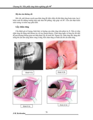 Chương IX: Tiểu phẫu răng khôn nghiêng gần 900



   Độ sâu của đường cắt

    Khi cắt, mũi khoan xuyên qua thân răng để chắc chắn cắt đứt thân răng hoàn toàn, lưu ý
kiểm soát tốt những trường hợp mặt nhai R8 phẳng, tiếp giáp với R7. Cần cẩn thận kiểm
soát xương và niêm mạc phía lưỡi.

   Lấy chân răng
    Cần đánh giá số lượng, hình thái và hướng của chân răng trên phim tia X. Nếu có chia
chân răng thì dùng mũi khoan trụ với tay khoan khuỷu. Chân răng ngắn và lỏng lẻo thì nhổ
dễ qua khoảng không gian nơi thân được lấy đi trước đó. Ngược lại, chân răng dài, dạng dùi
trống thì cần làm rộng thêm vùng ổ răng. Khi chân răng có hình cầu thì cắt chân răng.




                 Hình 9-5a                                  Hình 9-5b




                                                              Hình 9-5d
             Hình 9-5c


                             70
J-M. Korbendau  ___________________________________
 