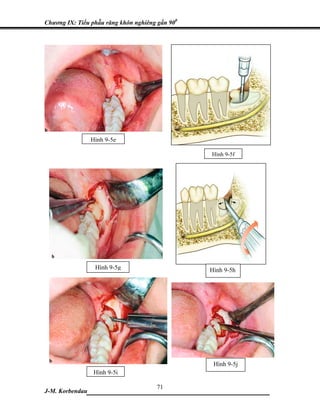 Chương IX: Tiểu phẫu răng khôn nghiêng gần 900




                 Hình 9-5e

                                                 Hình 9-5f




                  Hình 9-5g                      Hình 9-5h




                                                  Hình 9-5j
                  Hình 9-5i

                           71
J-M. Korbendau___________________________________
 
