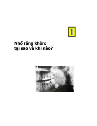 Nhổ răng khôn:
tại sao và khi nào?
 