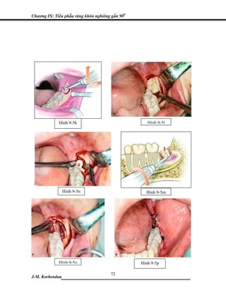 Chương IX: Tiểu phẫu răng khôn nghiêng gần 900




             Hình 9-5k                              Hình 9-5l




                 Hình 9-5n                         Hình 9-5m




             Hình 9-5o                           Hình 9-5p

                           72
J-M. Korbendau___________________________________
 