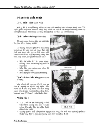 Chương IX: Tiểu phẫu răng khôn nghiêng gần 900




   Độ khó của phẫu thuật
   Độ A: thân- thân (hình 9-1a)
    Múi xa R8 lộ trong khoang miệng, cổ răng phía xa cũng nằm trên mặt phẳng nhai. Với
loại I, phẫu thuật tiến hành dễ dàng. Tuy nhiên với loại II, III (răng nằm trong cành cao
xương hàm dưới) thì mức độ khó tăng dần đặc biệt cho thao tác cắt thân răng.

   Độ B: thân- cổ răng ( hình 9-1b).
    R8 nằm ngang thường tiếp xúc với thân
lẫn chân R7 và thường loại II.

   Mô xương bao phủ phía trên thân răng
không nên lấy đến mức cổ răng. Tạo một
rãnh dọc theo mặt xa của R8 bằng mũi
khoan tròn nhằm loại bỏ đường vòng lớn
nhất. Tuy nhiên, các yếu tố sau cần lưu ý:

   •   Bộc lộ chân R7 là quan trọng,
       thường có độ sâu tương ứng với R8
       mọc lệch.
   •   Nếu thân răng ngầm càng rộng thì                       Hình 9-6a
       càng khó lấy răng.
   •   Hình dạng và hướng của chân răng.

   Độ C: thân- chân răng (hình 9-6a
   & 9-6b).

   Như trên đã đề cập, cần bộc lộ phía xa
chân R7 ngang với độ sâu răng ngầm. Nếu
phim tia X cho thấy hình ảnh chân răng
ngầm tiến sát đến ống thần kinh răng dưới,
khảo sát bằng CT-Scan 3 chiều là cần thiết.

   Những lưu ý

   •   Tỉ lệ C đối với R8 nằm ngang sẽ cho
       biết thành xương phía má và lưỡi
       mỏng. Cần cẩn thận khi phẫu thuật                      Hình 9-6b
       (hình 9-6a, 9-6b)
   •   Đường rạch và thiết kế vạt niêm mạc phải đủ rộng, cần thiết phải tách một phần cơ
       thuộc vùng thân và cành cao xương hàm dưới trong loại II, III.

                             73
J-M. Korbendau  ___________________________________
 