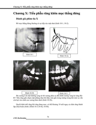 Chương X: Tiểu phẫu răng khôn mọc thẳng đứng


Chương X: Tiểu phẫu răng khôn mọc thẳng đứng
   Đánh giá phim tia X
   R8 mọc thẳng đứng thường có sự tiếp xúc mặt nhai (hình 10-1, 10-2).




                 Hình 10-1
                                                           Hình 10-2a




               Hình 10-2b                                 Hình 10-3
   Bờ xương ổ là một đường cong từ bờ xương phía xa đến đỉnh xương vùng kẻ răng R6-
R7. Nếu răng gần chạm mặt phẳng nhai thì thấy múi gần trong miệng trong khi múi xa vẫn
còn kẹt vào cành cao xương hàm dưới (hình 10-2b).

    Quyết định nhổ răng khi răng đang mọc, có thể khoảng 10 tuổi ngay cả chân răng thành
lập chưa hoàn chỉnh. (Hình 10-3;10-4a; 10-4b).




                             76
J-M. Korbendau  ___________________________________
 