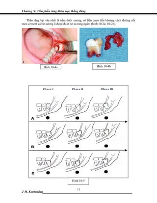 Chương X: Tiểu phẫu răng khôn mọc thẳng đứng

   Thân răng kẹt sâu nhất là nằm dưới xương, có liên quan đến khoảng cách đường nối
men-cement và bờ xương ổ được đo ở bờ xa răng ngầm (hình 10-2a; 10-2b).




                 Hình 10-4a                           Hình 10-4b




                                    Hình 10-5

                            77
J-M. Korbendau ___________________________________
 