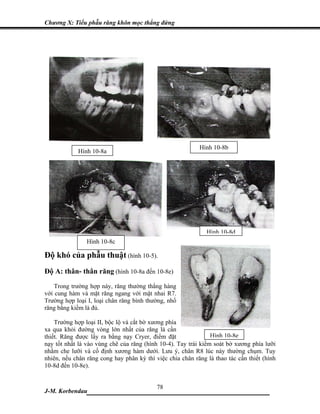 Chương X: Tiểu phẫu răng khôn mọc thẳng đứng




                                                           Hình 10-8b
            Hình 10-8a




                                                              Hình 10-8d
                Hình 10-8c

Độ khó của phẫu thuật (hình 10-5).
Độ A: thân- thân răng (hình 10-8a đến 10-8e)
    Trong trường hợp này, răng thường thẳng hàng
với cung hàm và mặt răng ngang với mặt nhai R7.
Trường hợp loại I, loại chân răng bình thường, nhổ
răng bằng kiềm là đủ.

    Trường hợp loại II, bộc lộ và cắt bờ xương phía
xa qua khỏi đường vòng lớn nhất của răng là cần
thiết. Răng được lấy ra bằng nạy Cryer, điểm đặt                Hình 10-8e
nạy tốt nhất là vào vùng chẽ của răng (hình 10-4). Tay trái kiểm soát bờ xương phía lưỡi
nhằm che lưỡi và cố định xương hàm dưới. Lưu ý, chân R8 lúc này thường chụm. Tuy
nhiên, nếu chân răng cong hay phân kỳ thì việc chia chân răng là thao tác cần thiết (hình
10-8d đến 10-8e).


                             78
J-M. Korbendau  ___________________________________
 