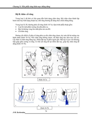 Chương X: Tiểu phẫu răng khôn mọc thẳng đứng



   Độ B: thân- cổ răng
   Trong loại I, độ khó có liên quan đến hình dạng chân răng. Khi chân chưa thành lập
hoàn toàn hay hình dạng thuận lợi, nhổ răng thường dễ dàng theo chiều thẳng đứng.

   Trong loại II, III, thường phải cắt răng (hình 10-7a). Quá trình phẫu thuật gồm:
   • Loại bỏ một phần xương che phủ phía xa.
   • Bộc lộ đường vòng lớn nhất phía má của R8.
   • Cắt thân răng.

    Đường cắt chếch về phía cổ răng phía xa nếu chân răng chụm, tùy mức độ há miệng của
bệnh nhân (hình 10-7a). Nếu chân răng không chụm, cắt thân răng dọc theo trục của nó.
Lấy thân và chân răng bằng nạy. Điểm đặt nạy là phía ngoài gần. Đặt nạy Cryer vào khoảng
tiếp giáp giữa xương và răng. Có thể cắt răng để tạo điểm đặt nạy, giúp lấy chân răng dễ
dàng (hình 10-7b).




                                   Hình 10-7a




                                     Hình 10-7b
                             79
J-M. Korbendau  ___________________________________
 