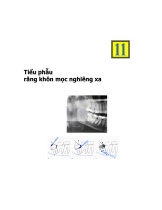 T i ể u p hẫ u
răng khôn mọc nghiêng xa
 