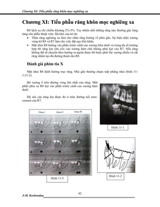 Chương XI: Tiểu phẫu răng khôn mọc nghiêng xa


Chương XI: Tiểu phẫu răng khôn mọc nghiêng xa
   R8 lệch xa chỉ chiếm khoảng 2%-5%. Tuy nhiên nhổ những răng này thường gây lúng
túng cho phẫu thuật viên. Độ khó của nó do:
   • Thân răng nghiêng xa làm cho chân răng hướng về phía gần. Sự hiện diện xương
       vùng kẽ R8 và R7 làm cho việc đặt nạy khó khăn.
   • Mặt nhai R8 hướng vào phần trước cành cao xương hàm dưới và trong đa số trường
       hợp thì răng kẹt chủ yếu vào xương hàm chứ không phải kẹt vào R7. Nếu răng
       không thể di chuyển theo hướng ra ngoài được thì buộc phải lấy xương nhiều và cắt
       răng nhằm tạo đủ đường thoát cho R8.

   Đánh giá phim tia X
   Mặt nhai R8 định hướng trục răng. Múi gần thường chạm mặt phẳng nhai (hình 11-
1;11-2).

   Bờ xương ổ trên đường vòng lớn nhất của răng. Một
phần phía xa R8 kẹt vào phần trước cành cao xương hàm
dưới.

   Độ sâu của răng kẹt được đo ở mức đường nối men-
cement của R7.




                                                                   Hình 11-1




                                                                  Hình 11-2
                     Hình 11-5



                             82
J-M. Korbendau  ___________________________________
 