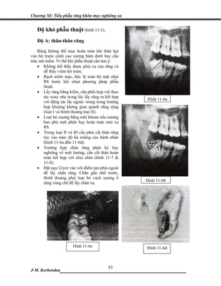 Chương XI: Tiểu phẫu răng khôn mọc nghiêng xa


   Độ khó phẫu thuật (hình 11-5).
   Độ A: thân-thân răng
    Răng không thể mọc hoàn toàn khi thân kẹt
vào bờ trước cành cao xương hàm dưới hay cấu
trúc mô mềm. Vì thế khi phẫu thuật cần lưu ý:
    • Không thể thấy được phía xa của răng và
       dễ thấy viêm lợi trùm.
    • Rạch niêm mạc, bộc lộ toàn bộ mặt nhai
       R8 trước khi chọn phương pháp phẫu
       thuật.
    • Lấy răng bằng kiềm, cần phối hợp với thao
       tác xoay nhẹ trong lúc lấy răng ra kết hợp
                                                    Hình 11-6a
       với động tác lắc ngoài- trong trong trường
       hợp khoảng không gian quanh răng rộng
       (loại I và thỉnh thoảng loại II).
    • Loại bỏ xương bằng mũi khoan nếu xương
       bao phủ một phần hay hoàn toàn múi xa
       R8.
    • Trong loại II và III cần phải cắt thân răng
       tùy vào mức độ há miệng của bệnh nhân
       (hình 11-6a đến 11-6d).
    • Trường hợp chân răng phân kỳ hay
       nghiêng về một hướng, cần cắt thân hoàn
       toàn kết hợp với chia chân (hình 11-7 &
       11-8).
    • Đặt nạy Cryer vào với điểm tựa phía ngoài
       để lấy chân răng. Chân gần nhổ trước,
       thỉnh thoảng phải loại bỏ vách xương ổ
                                                    Hình 11-6b
       răng vùng chẽ để lấy chân xa.




                       Hình 11-6c                   Hình 11-6d



                             83
J-M. Korbendau  ___________________________________
 
