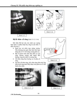 Chương XI: Tiểu phẫu răng khôn mọc nghiêng xa




                                                            Hình 11-8

             Hình 11-7

   Độ B: thân- cổ răng (hình 11-3; 11-4)
    Khi thân R8 kẹt sâu vào cành cao xương
hàm dưới và phẫu thuật lấy răng là cần thiết. 4
điều cần lưu ý:
    • Rạch tạo vạt niêm mạc màng xương.
       Nếu khoảng tam giác hậu hàm nhỏ hẹp,
       dùng dao số 15 cắt màng xương phía xa.
    • Bộc lộ hoàn toàn mặt nhai phía xa của
       răng. Khoan xương mặt ngoài đến
       đường vòng lớn nhất và xương xốp.
    • Cắt thân răng theo hướng xa về phía cổ
       răng.                                                     Hình 11-9
    • Sau khi cắt thân răng, nếu chân răng nằm trên ống
       thần kinh răng dưới thấy được trên phim tia X tiến
       hành chia chân.




                      Hình 11-3                                         Hình 11-4


                             84
J-M. Korbendau  ___________________________________
 