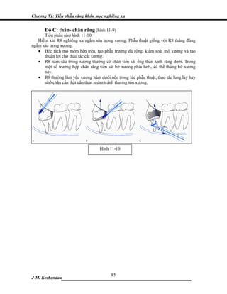 Chương XI: Tiểu phẫu răng khôn mọc nghiêng xa


      Độ C: thân- chân răng (hình 11-9)
      Tiểu phẫu như hình 11-10.
   Hiếm khi R8 nghiêng xa ngầm sâu trong xương. Phẫu thuật giống với R8 thẳng đứng
ngầm sâu trong xương:
   • Bóc tách mô mềm bên trên, tạo phẫu trường đủ rộng, kiểm soát mô xương và tạo
      thuận lợi cho thao tác cắt xương.
   • R8 nằm sâu trong xương thường có chân tiến sát ống thần kinh răng dưới. Trong
      một số trường hợp chân răng tiến sát bờ xương phía lưỡi, có thể thủng bờ xương
      này.
   • R8 thường làm yếu xương hàm dưới nên trong lúc phẫu thuật, thao tác lung lay hay
      nhổ chân cần thật cẩn thận nhằm tránh thương tổn xương.




                                   Hình 11-10




                            85
J-M. Korbendau ___________________________________
 