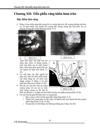 Chương XII: tiểu phẫu răng khôn hàm trên


Chương XII: Tiểu phẫu răng khôn hàm trên
   Đặc điểm lâm sàng
   •   Răng và bao mầm răng nằm trong lồi củ xương hàm trên. Bè xương thường xốp hơn
       so với hàm dưới, bao quanh bởi xương đặc nhưng mỏng đặc biệt phía sau có
       khuynh hướng dễ vỡ khi nhổ răng (hình 12-1).

   •   L
       ồ
       i

       c
       ủ

       x
       ư
       ơ
       n
       g          Hình 12-1                                 Hình 12-2a
        hàm trên được bao phủ bởi mô
       niêm mạc nướu và màng xương.
       Giới hạn phía sau là rãnh bướm
       hàm, niêm mạc phía ngoài liên tục
       với ngách lợi hàm trên (hình 12-
       2a).
   •   Cơ mút bám vào đáy ngách lợi
       hàm trên. Khi kết thúc phẫu thuật,
       cần khâu đóng lại vạt niêm mạc
       màng xương về đúng vị trí giải
       phẫu ban đầu của nó (hình 12-2b).
   •   Khi lật vạt cần bóc tách kỹ màng
       xương cùng với các sợi cơ mút;
                                                           Hình 12-2b
       rách màng xương có thể làm lộ
       khối mở Bichat’s, và thậm chí làm khối mở này vào phẫu trường (hình 12-2b).
   •   Có mối liên hệ giữa R8 hàm trên và xoang hàm:
           o Đáy xoang có thể có liên quan đến chóp răng (hình 12-3).
           o Thành sau xoang hàm có thể cùng với thành trước hay thành bên bao quanh
              mầm răng (hình 12-4a; 12-4b).
           o Xoang hàm có thể thông vào khoang miệng qua ổ răng vừa nhổ.




                            87
J-M. Korbendau ___________________________________
 