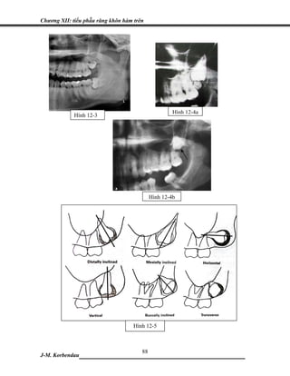 Chương XII: tiểu phẫu răng khôn hàm trên




                                                    Hình 12-4a
             Hình 12-3




                                           Hình 12-4b




                                    Hình 12-5



                            88
J-M. Korbendau ___________________________________
 