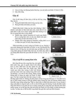 Chương XII: tiểu phẫu răng khôn hàm trên


   •   Làm rơi răng vào khoang bướm hàm hay vào mô mềm má (hình 12-9a & 12-9b).
   •   Gãy chân răng.

   Gây tê
  Gây tê nhổ răng cối hàm trên có thể tại chổ hay vùng.
Mục tiêu là:
  • Phong bế nhánh thần kinh ổ răng sau hay trên.
  • Phong bế thần kinh khẩu cái trước.

    Nhánh thần kinh ổ răng sau hay trên (thường 2 đến 3
nhánh) xuất phát từ thần kinh hàm trên, trước khi đi vào
rãnh dưới ổ mắt; nó ra trước xuống dưới theo hướng ra xa
lồi củ xương hàm trên và cho nhánh:
    • Nhánh răng: (dental branches) đi xuyên qua thành
        lồi củ xương hàm trên và cho các nhánh cảm giác             Hình 12-9a
        chân răng cối hàm trên (hình 12-10).
    • Nhánh nướu răng (gingival branches) xuống dưới ra xa
        và nhận cảm giác từ nướu răng tương ứng.

   Thần kinh khẩu cái trước xuống tại lổ khẩu cái sau, khoảng 2
mm trước đường giới hạn khẩu cái trước và sau. Sự khuyếch tán
thuốc tê vào vị trí này tùy vào mô niêm mạc sợi khẩu cái. Gây tê
vùng nhằm phong bế nhánh thần kinh này chỉ nhằm duy nhất là
can thiệp phẫu thuật liên quan đến R8 (hình 12-11a; 12-11b; 12-
11c).                                                                   Hình 12-9b


   Gây tê tại lồi củ xương hàm trên
    Khi răng đã mọc trên cung hàm hay còn ngầm
dưới niêm mạc, gây tê quanh chóp là đủ (dùng
kim 21 mm). Đâm kim vào đáy ngách lợi, dọc
theo lồi củ xương hàm trên tương ứng. Đâm
xuyên qua niêm mạc xương ổ phía trên đường
giới hạn nướu niêm mạc miệng trong rãnh nướu-
má khoảng 1 cm tính từ nền xương. Màng xương
không phải là hàng rào ngăn cản thuốc tê thấm
qua. Các bản xương hàm trên khá mỏng và xốp,                        Hình 12-10
dễ dàng ngấm thuốc tê. Không cần phải chạm xương trong quá trình gây tê. Cần nhắc lại là
gây tê dưới màng xương có thể gây phồng màng xương hay làm tổn thương những mạch
máu đến vùng xương tương ứng. Thật ra, mạch máu và thần kinh phía trước và sau xương ổ
răng xuất phát từ vùng kế cạnh, xa lồi củ nên rất khó gây tổn thương. Gaudy đã nhấn mạnh
rằng tiêm thuốc tê vào giữa mô sợi và màng xương thì có cùng hiệu quả như khi tiêm dưới
màng xương; nó có thể gây đau cấp tính trước khi thuốc tê có tác dụng và thỉnh thoảng gây
tụ máu. Tụ máu này có thể lan đến vùng thành hầu gây khó nuốt tạm thời (Gaudy).

                             90
J-M. Korbendau  ___________________________________
 