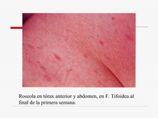 Roseola en tórax anterior y abdomen, en F. Tifoidea al final de la primera semana. 