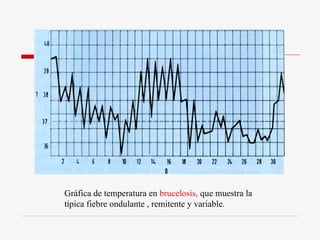 Gráfica de temperatura en  brucelosis,  que muestra la típica fiebre ondulante , remitente y variable. 