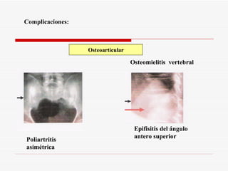 Osteoarticular Complicaciones: Osteomielitis  vertebral Poliartritis asimétrica Epifisitis del ángulo  antero superior 