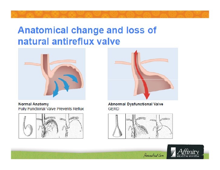 Natural Gerd Treatment Options Natural Gerd Treatment Options
