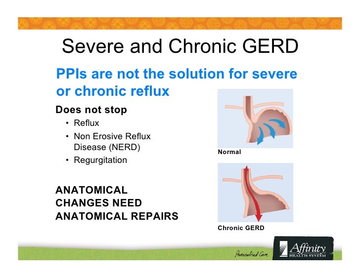 Acid reflux disease long term