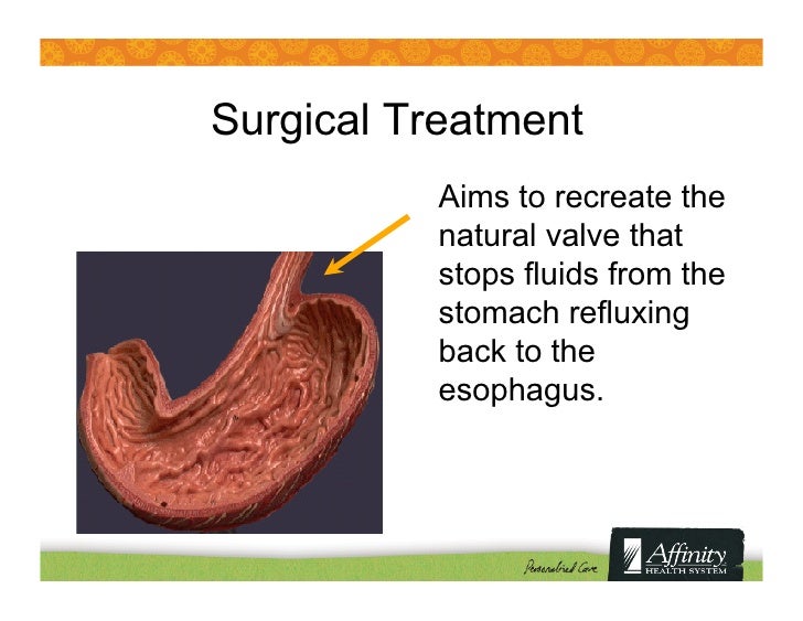 Heartburn and Acid Reflux: Causes & New Treatment Options