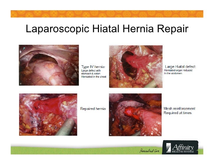 Hiatal Hernia Natural Treatment Options Hiatal Hernia Natural Treatment Options