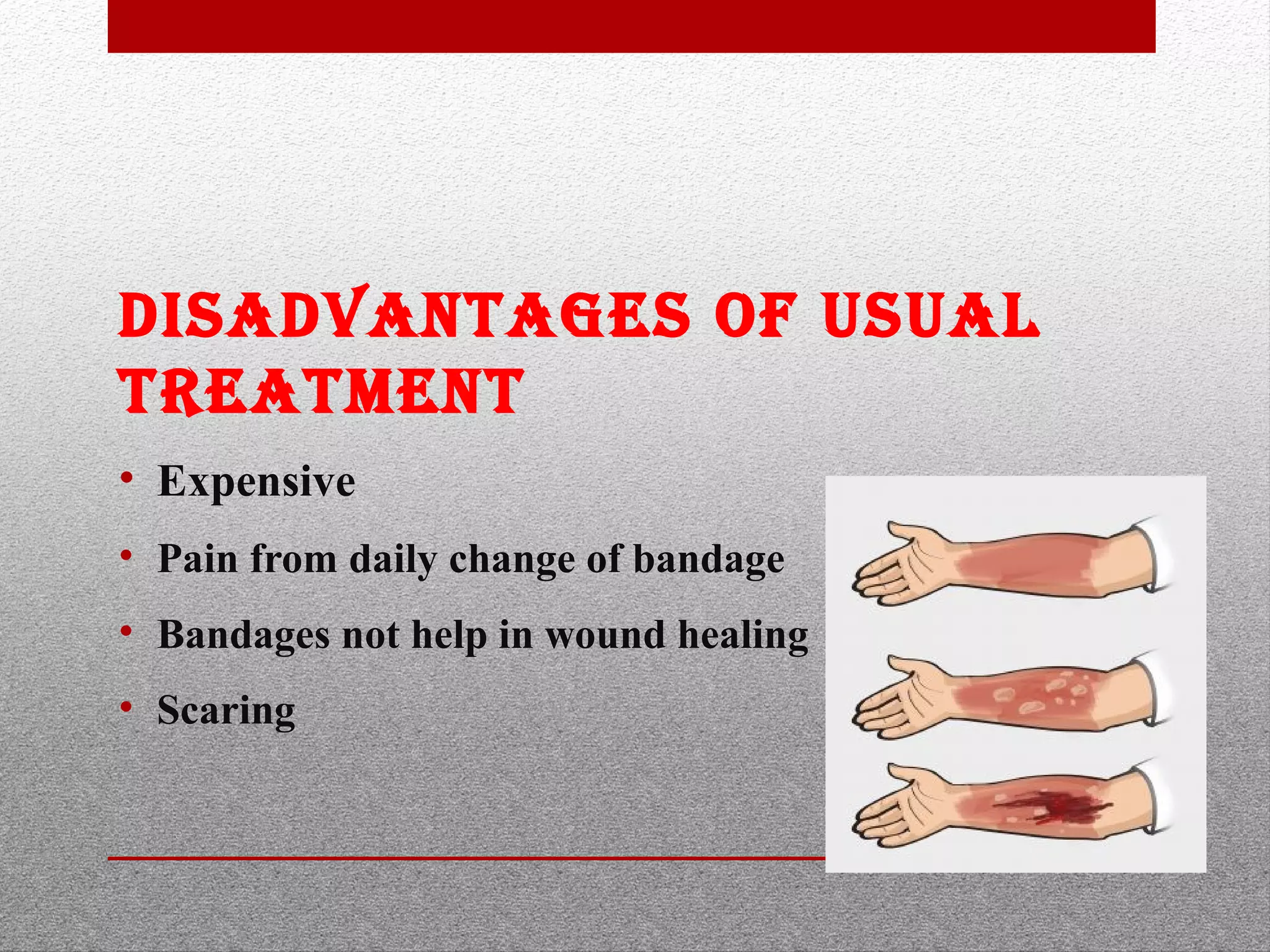 Tilapia skin burn bandage