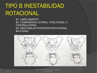 TIPO B INESTABILIDAD
ROTACIONAL
18/07/16
MG, HTAL MISERICORDIA, CORDOBA,
ARGENTINA
B1: LIBRO ABIERTO
B2: COMPRESION LATERAL: IPSILATERAL O
CONTRALATERAL
B3: INESTABILAD POSTERIOR ROTACIONAL
BILATERAL
 