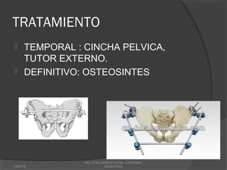 TRATAMIENTO
 TEMPORAL : CINCHA PELVICA,
TUTOR EXTERNO.
 DEFINITIVO: OSTEOSINTES
18/07/16
MG, HTAL MISERICORDIA, CORDOBA,
ARGENTINA
 