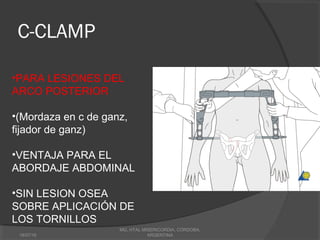 C-CLAMP
18/07/16
MG, HTAL MISERICORDIA, CORDOBA,
ARGENTINA
•PARA LESIONES DEL
ARCO POSTERIOR
•(Mordaza en c de ganz,
fijador de ganz)
•VENTAJA PARA EL
ABORDAJE ABDOMINAL
•SIN LESION OSEA
SOBRE APLICACIÓN DE
LOS TORNILLOS
 