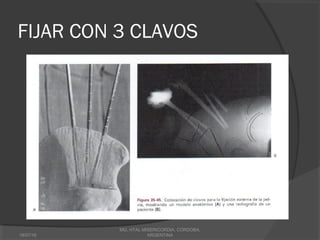 FIJAR CON 3 CLAVOS
18/07/16
MG, HTAL MISERICORDIA, CORDOBA,
ARGENTINA
 