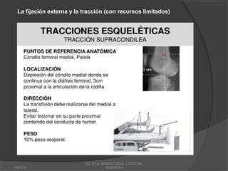 18/07/16
MG, HTAL MISERICORDIA, CORDOBA,
ARGENTINA
La fijación externa y la tracción (con recursos limitados)
 