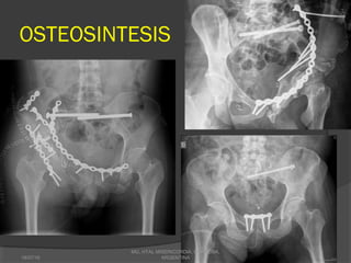OSTEOSINTESIS
18/07/16
MG, HTAL MISERICORDIA, CORDOBA,
ARGENTINA
 