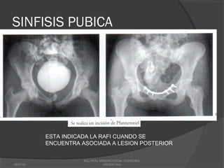 SINFISIS PUBICA
18/07/16
MG, HTAL MISERICORDIA, CORDOBA,
ARGENTINA
ESTA INDICADA LA RAFI CUANDO SE
ENCUENTRA ASOCIADA A LESION POSTERIOR
 