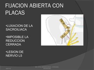 FIJACION ABIERTA CON
PLACAS
18/07/16
MG, HTAL MISERICORDIA, CORDOBA,
ARGENTINA
•LUXACION DE LA
SACROILIACA
•IMPOSIBLE LA
REDUCCION
CERRADA
•LESION DE
NERVIO L5
 