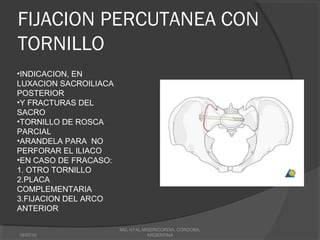 FIJACION PERCUTANEA CON
TORNILLO
18/07/16
MG, HTAL MISERICORDIA, CORDOBA,
ARGENTINA
•INDICACION, EN
LUXACION SACROILIACA
POSTERIOR
•Y FRACTURAS DEL
SACRO
•TORNILLO DE ROSCA
PARCIAL
•ARANDELA PARA NO
PERFORAR EL ILIACO
•EN CASO DE FRACASO:
1. OTRO TORNILLO
2.PLACA
COMPLEMENTARIA
3.FIJACION DEL ARCO
ANTERIOR
 