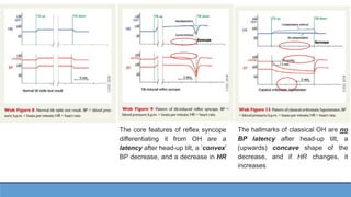 The core features of reflex syncope
differentiating it from OH are a
latency after head-up tilt, a ‘convex’
BP decrease, and a decrease in HR
The hallmarks of classical OH are no
BP latency after head-up tilt, a
(upwards) concave shape of the
decrease, and if HR changes, it
increases
 