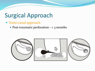 Time management in middle ear & mastoid surgery | PPSX